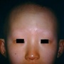 alopecia6-30.jpg