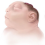 anencephaly-160750.png