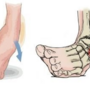 ankle_sprain-115749.png