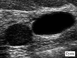 breast_cyst_ultrasound_2a.jpg