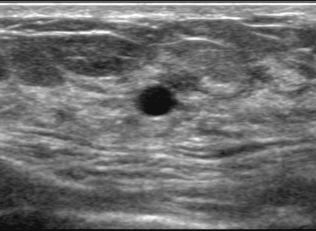 breast_sonography_0916182920.png