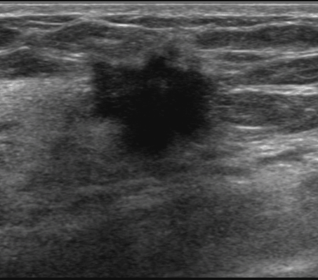 breast_sonography_0916182946.png