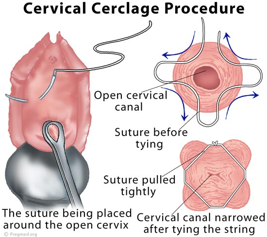 cervical_cerclage-203955.png