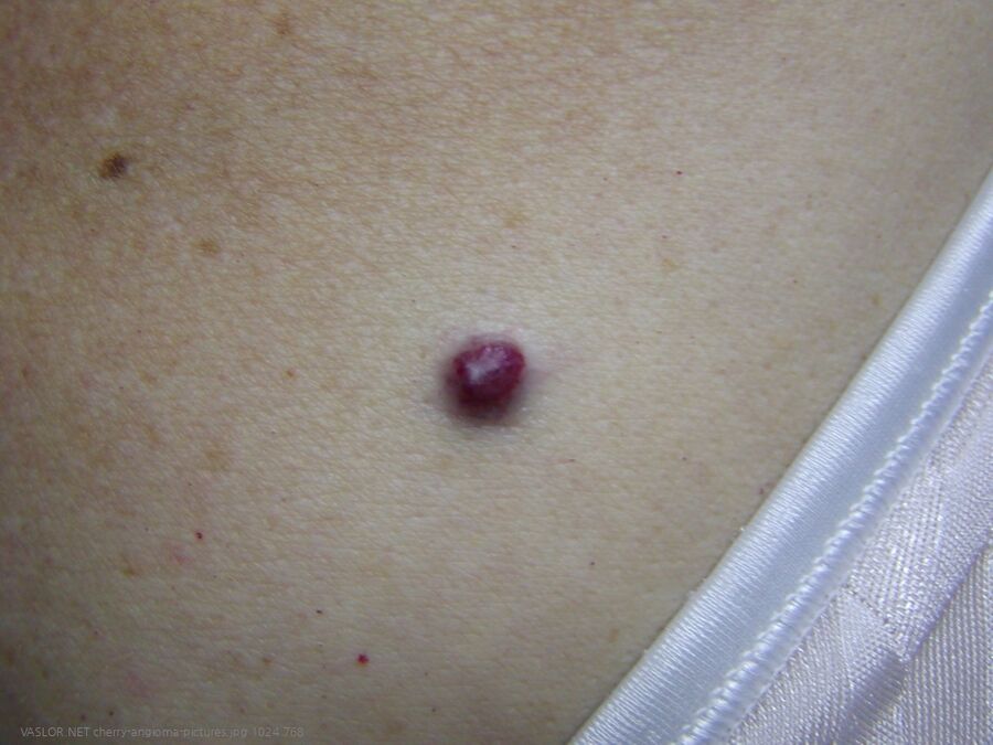 cherry-angioma-pictures.jpg