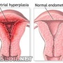 endometrial_hyperplasia.jpg