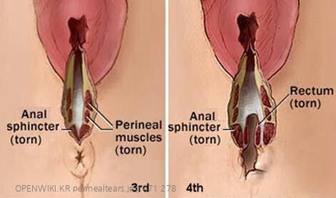 perinealtears.jpg