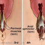 perinealtears.jpg