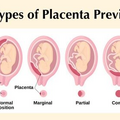 placenta_previa_4604.png