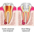 root_canal_treatment_2755.png