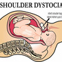 shoulder_dystocia.jpg