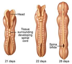 spina_bifida-neural_tube_caudal_neuropore.jpg