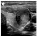 thyroid_ultrasonography_0534.png