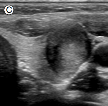 thyroid_ultrasonography_2034.png