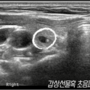 thyroid_ultrasonography_5741.png