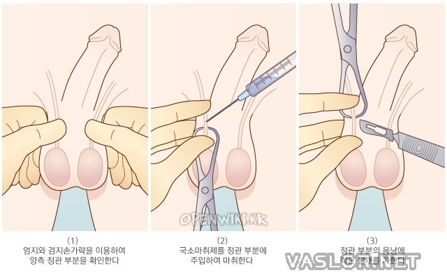 vasectomy01.jpg