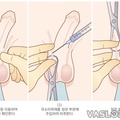 vasectomy01.jpg