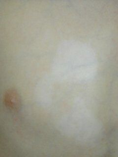 vitiligo010405.jpg