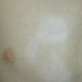 vitiligo010405.jpg