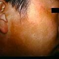 vitiligo13.jpg