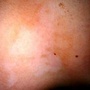 vitiligo8-199.jpg