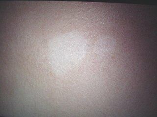 vitiligo8-471.jpg