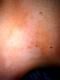 vitiligo_graft1.jpg