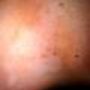 vitiligo_graft1.jpg