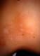 vitiligo_graft2.jpg
