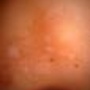 vitiligo_graft2.jpg