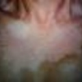 vitiligo_puva1.jpg