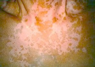 vitiligo_puva7-157.jpg