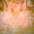 vitiligo_puva7-157.jpg