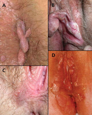  (A) genital warts, (B) vulvar intraepithelial neoplasia, (C) genital herpes, (D) condylomata lata