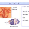 음경암.gif