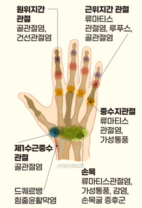 통풍_0616.png