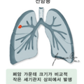 폐암_0325150139.png