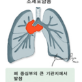 폐암_0325150520.png