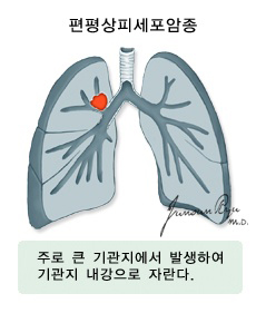 폐암_0325150558.png