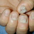 20naildystrophy0120204-2.jpg