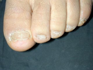 20naildystrophy0120204-3.jpg