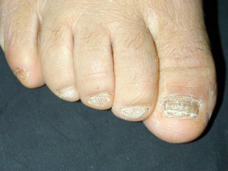 20naildystrophy0120204-4.jpg