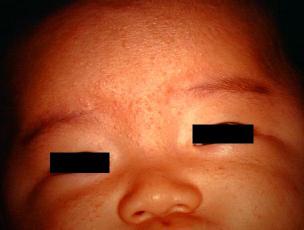 acne_neonatal8-587.jpg