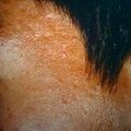 acne_nodulocystic13.jpg