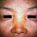 acne_senile2000-65.jpg