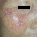 actinickeratosis020304.jpg