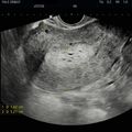 adenocarcinoma.jpg