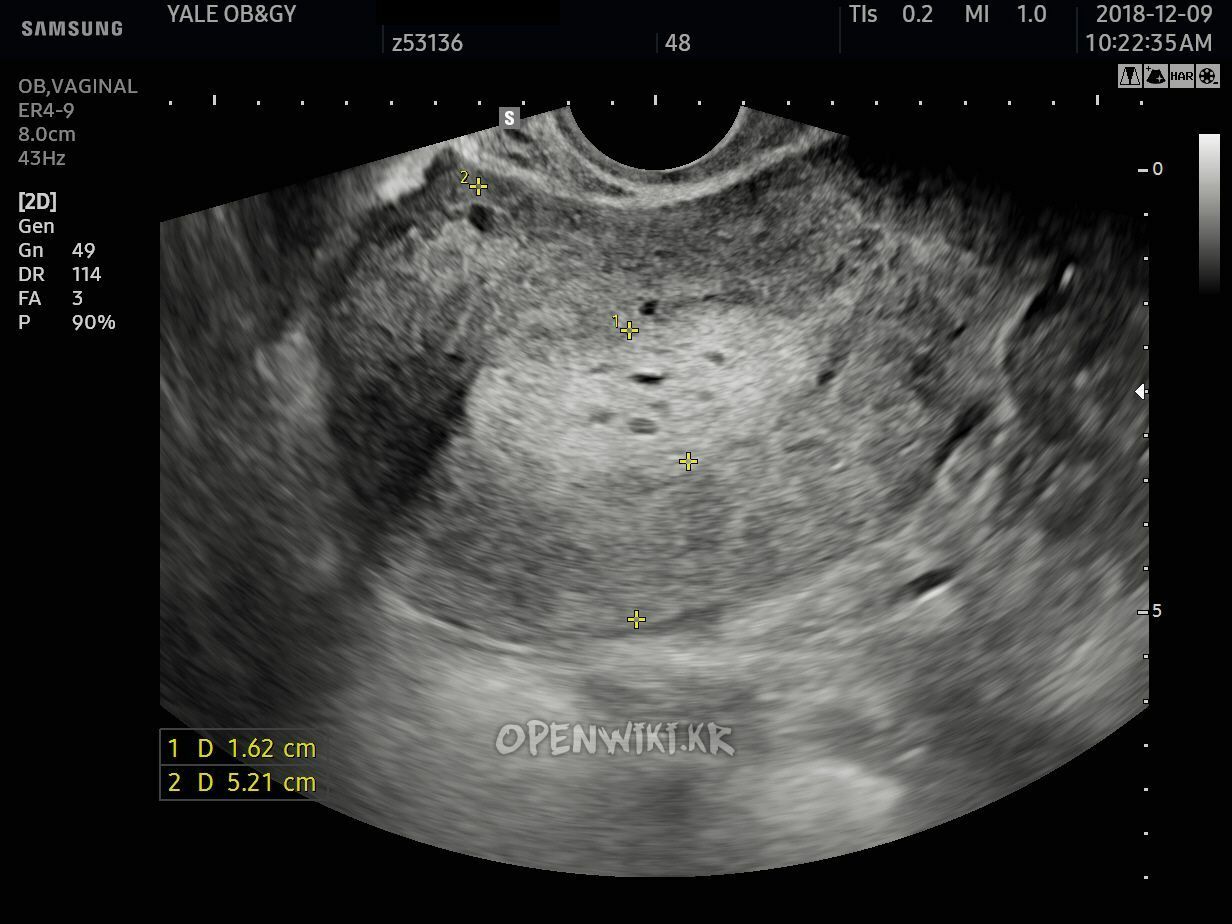adenocarcinoma.jpg