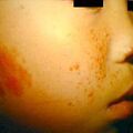adenomasebaceum1.jpg
