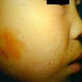 adenomasebaceum3.jpg