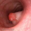 adenomatous_polyp.jpg